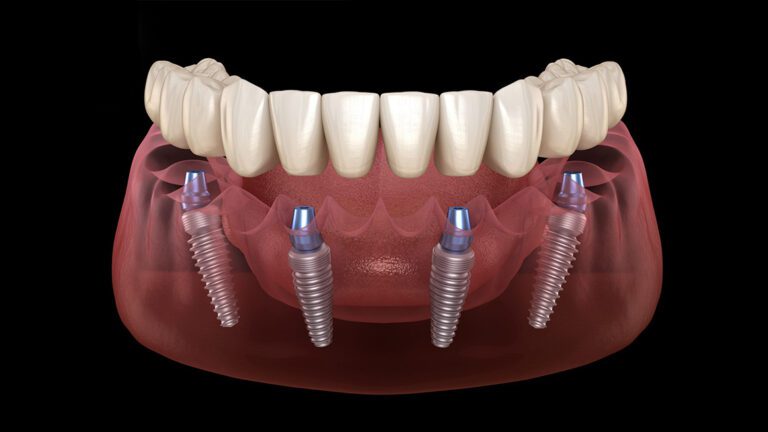الرئيسية All-on-4 - dental implant Имплантация челюсти «Все на 4 имплантах»