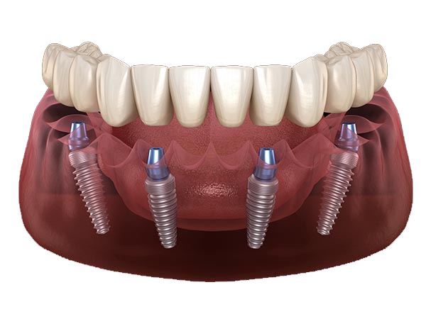 All on 4 vs All on 6 Dental Implants