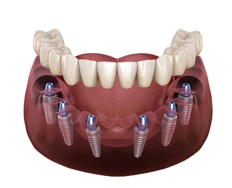 All on 4 vs All on 6 Dental Implants