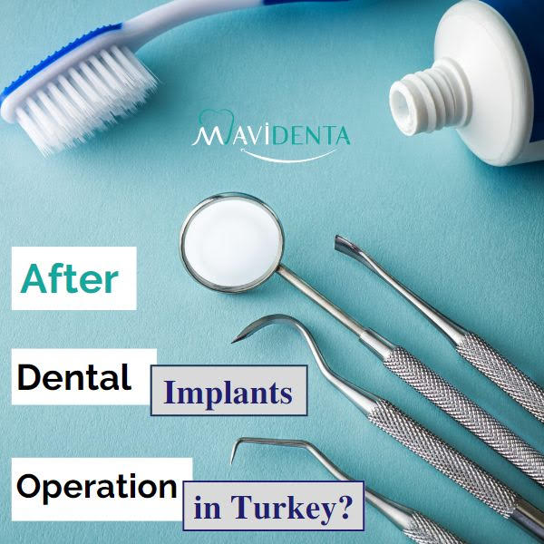 How Much Does a Full Set Of Dental Implants Cost In Turkey