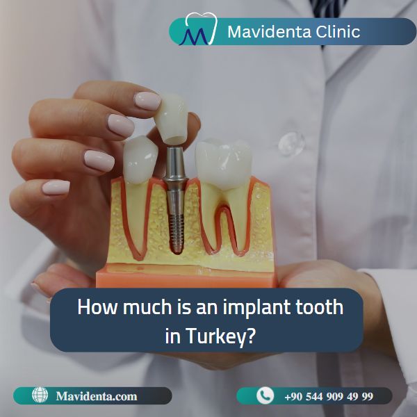 Single Tooth Denture Cost Single Tooth Denture Cost