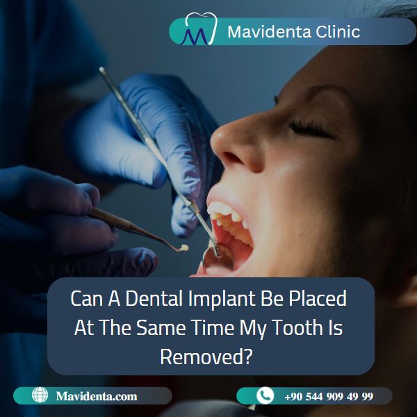 Front Tooth Extraction and Implant