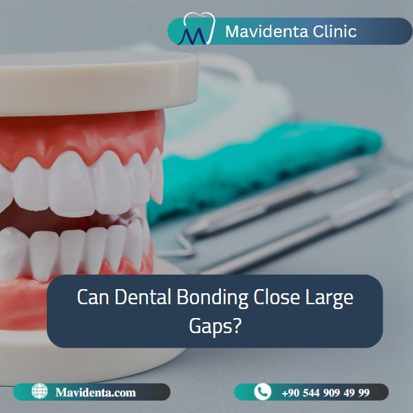 Dental Bonding Front Teeth Gap Cost Dental Bonding Front Teeth Gap Cost