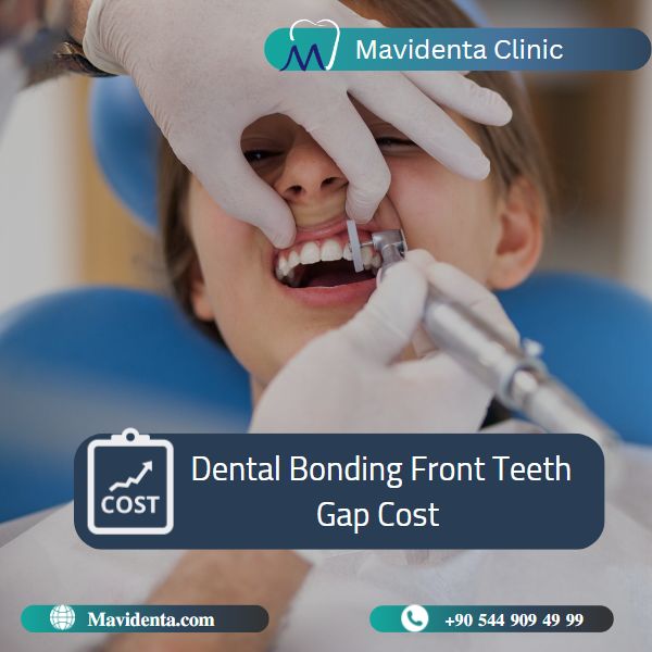 Dental Bonding Front Teeth Gap Cost Dental Bonding Front Teeth Gap Cost