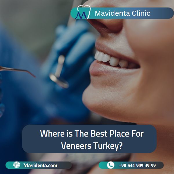 Best Place For Veneers Turkey   best place for veneers Turkey