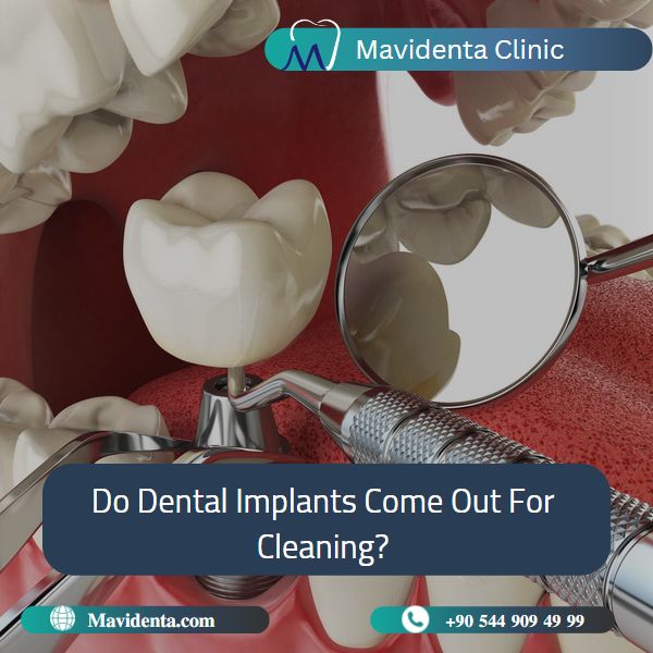 Dental Implant Cleaning Cost Dental Implant Cleaning Cost
