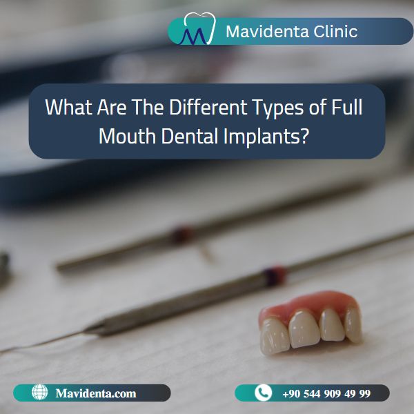 Complete Mouth Dental Implants Cost Complete Mouth Dental Implants Cost