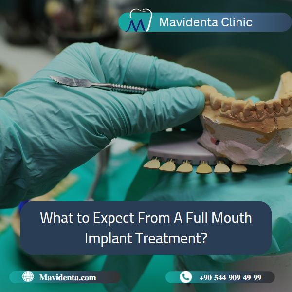 Complete Mouth Dental Implants Cost Complete Mouth Dental Implants Cost