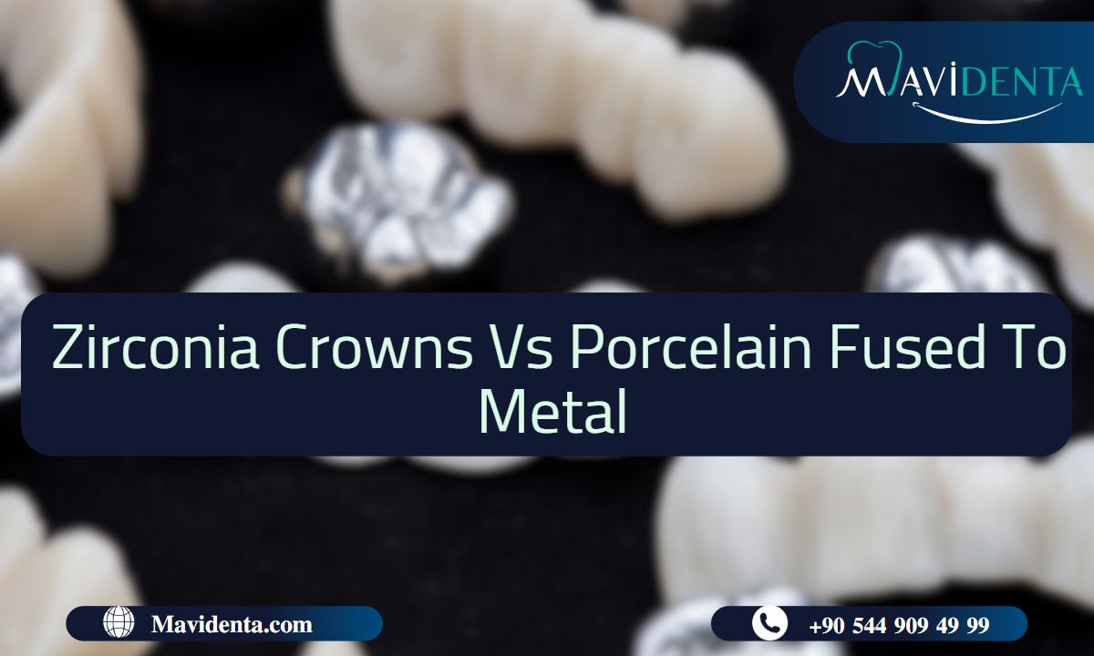Zirconia Crowns Vs Porcelain Fused To Metal