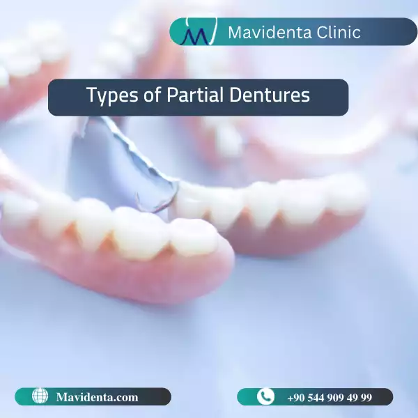Partial Dentures for Front Teeth Partial Dentures for Front Teeth