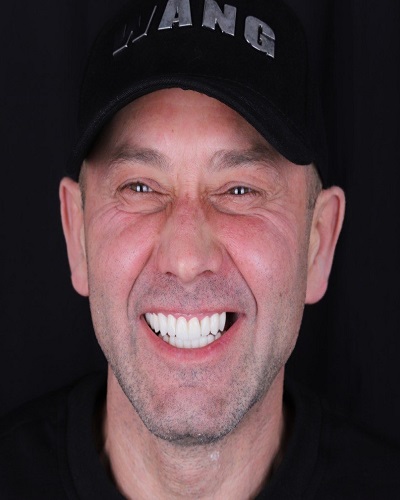 All on 4 Dental Implants All on 4 Dental Implants