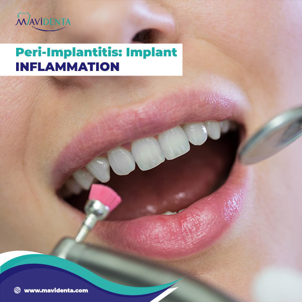 Dental Implant Problems years later Dental Implant Problems years later