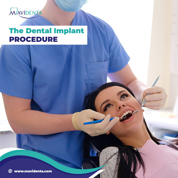 How Much Are Implants Per Tooth