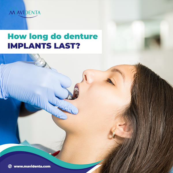 Average Cost For Denture Implants Average Cost For Denture Implants
