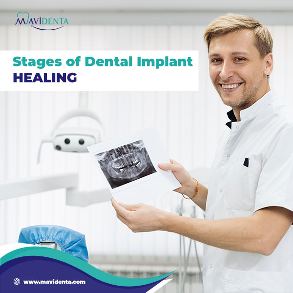 Implant Tooth Healing Time Implant Tooth Healing Time