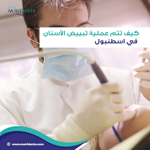 تبييض الأسنان في اسطنبول تبييض الأسنان في اسطنبول