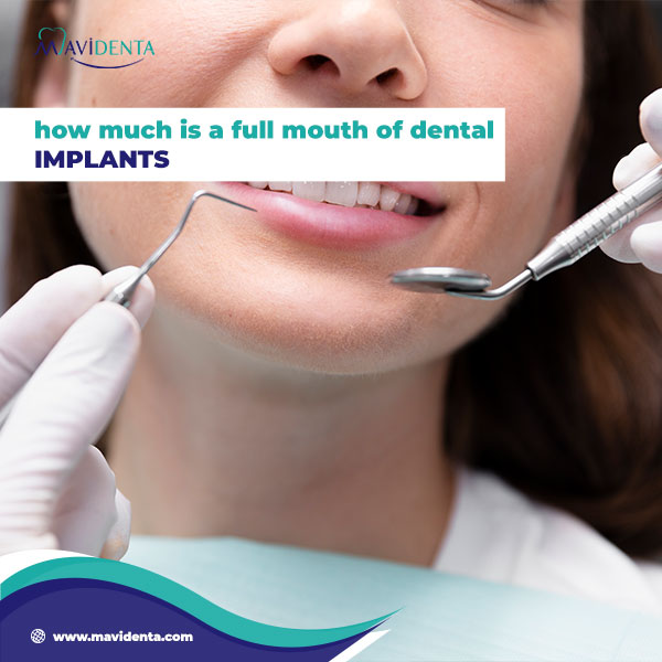 Dental implants full mouth cost Dental implants full mouth cost