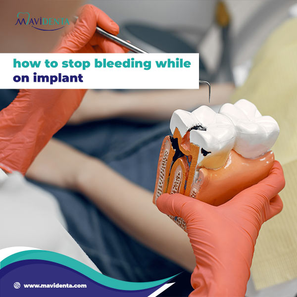 How To Stop Bleeding While On Implant How To Stop Bleeding While On Implant