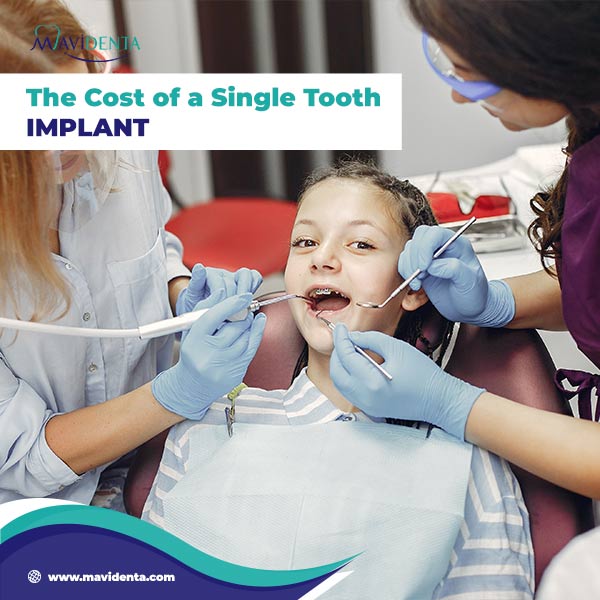 Dental Implants Cost Per Tooth Dental Implants Cost Per Tooth