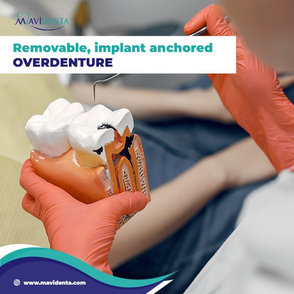 Can You Get Dental Implants If You Have No Teeth Can You Get Dental Implants If You Have No Teeth