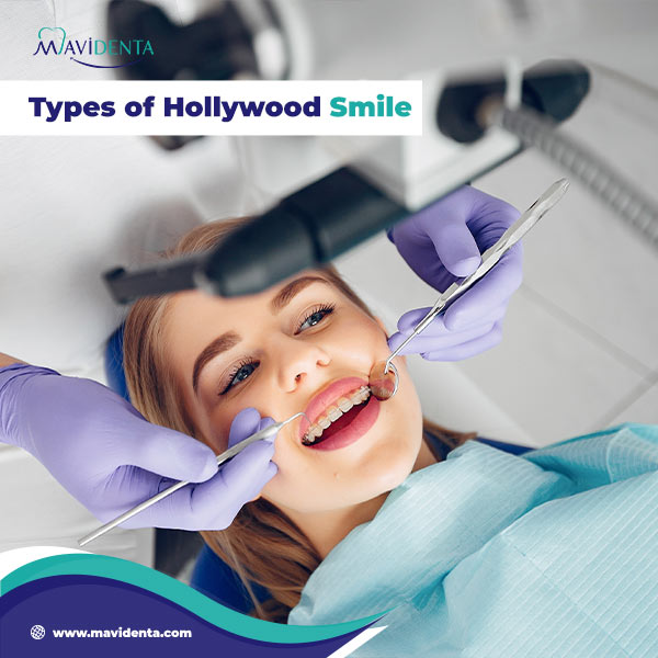 The Complete Guide to Hollywood Smile Dental Price Hollywood Smile Dental Price