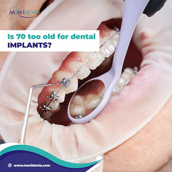 Dental Implants Cost for Seniors: Invest in Your Smile dental implants cost for seniors