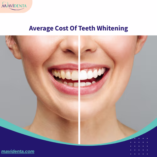 Average Cost Of Teeth Whitening Average Cost Of Teeth Whitening