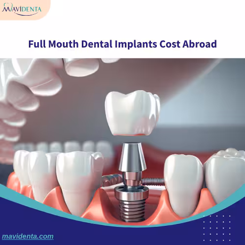 Dental Implants For The Entire Mouth Dental Implants For The Entire Mouth