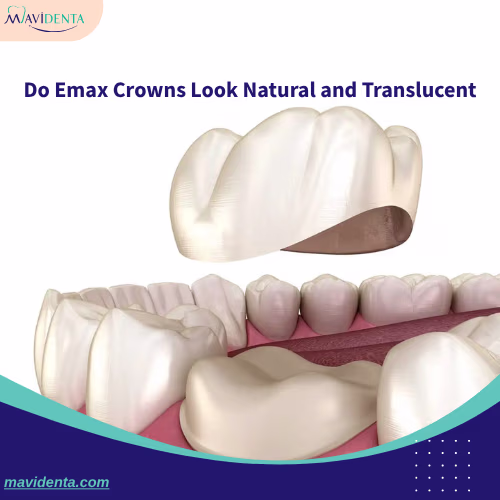 Types of Emax Crowns Do Emax Crowns Look Natural and Translucent