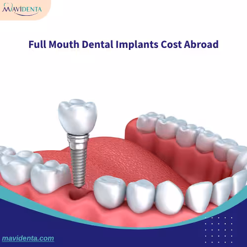 Full Mouth Dental Implants Cost Abroad Full Mouth Dental Implants Cost Abroad