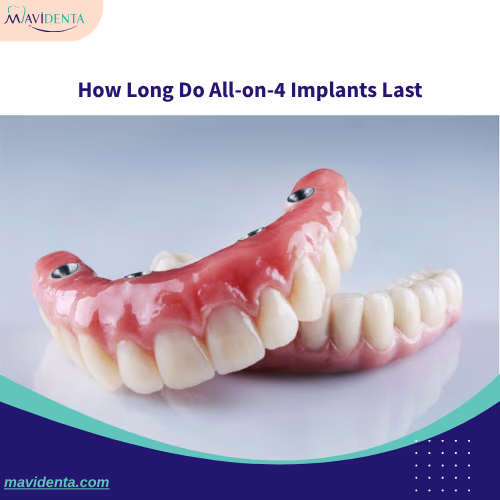 How Much Are All-On-4 Dental Implants? How Long Do All-on-4 Implants Last
