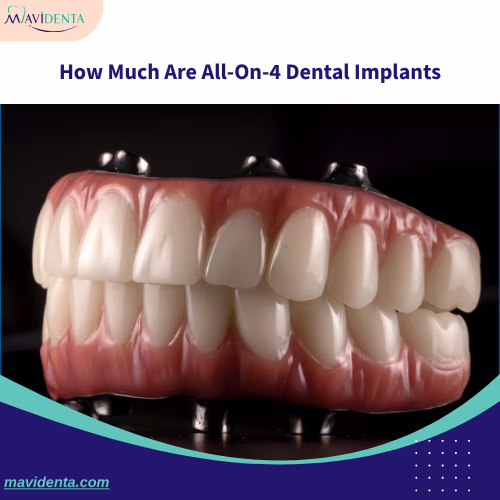 How Much Are All-On-4 Dental Implants? How Much Are All-On-4 Dental Implants