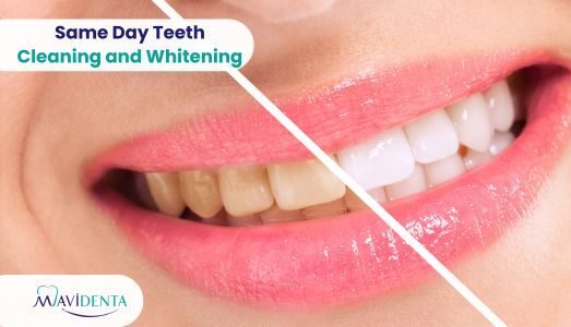 Same Day Teeth Cleaning and Whitening