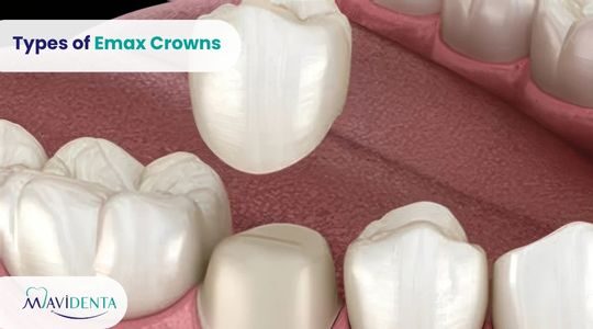 Types of Emax Crowns