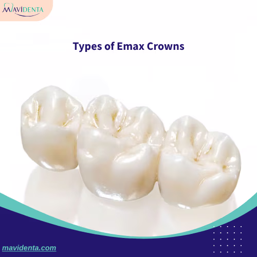 Types of Emax Crowns Types of Emax Crowns