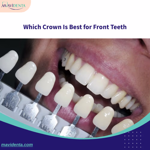 Emax Dental Crown Price Which Crown Is Best for Front Teeth