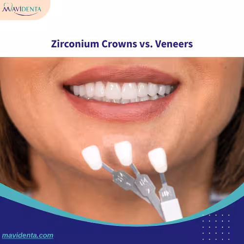Zirconium Crowns vs. Veneers Zirconium Crowns vs. Veneers