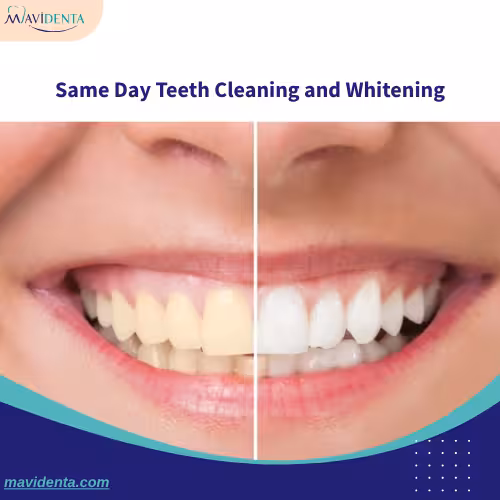 Same Day Teeth Cleaning and Whitening Same Day Teeth Cleaning and Whitening
