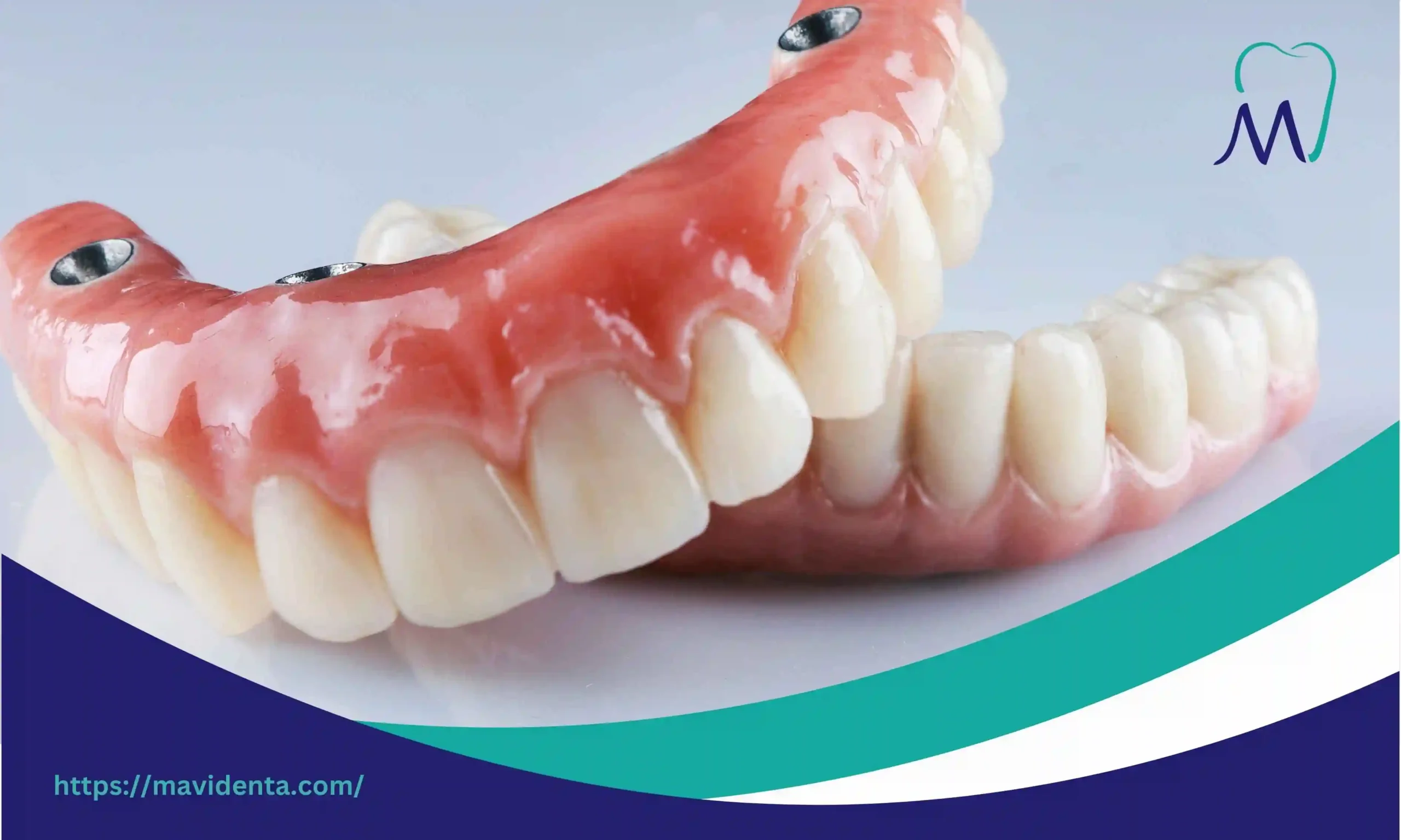 Cost of All on 4 Dental Implants Turkey Explained Clearly Cost of All on 4 Dental Implants Turkey