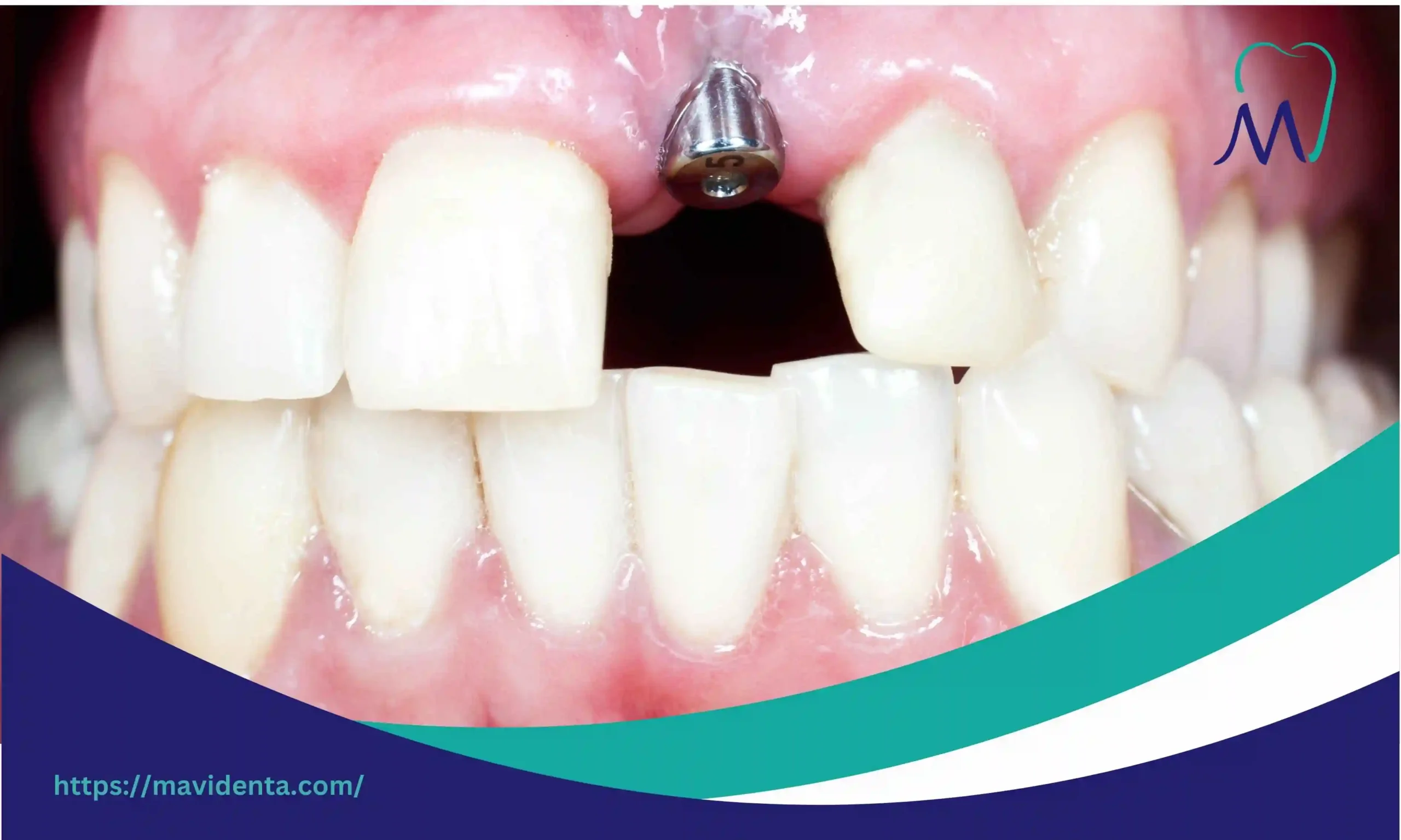 Discover the True Cost of 1 Dental Implant in Turkey cost of 1 dental implant