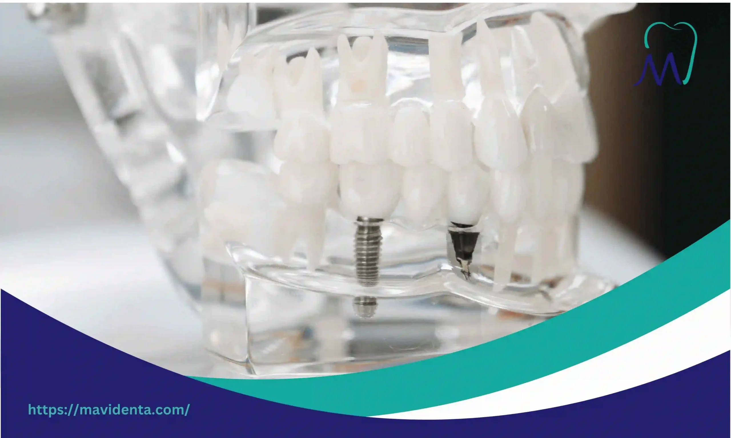 Cost of 2 Dental Implants with Bone Grafting Explained cost of 2 dental implants with bone grafting
