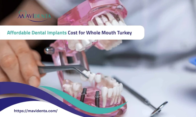 dental implants cost for whole mouth