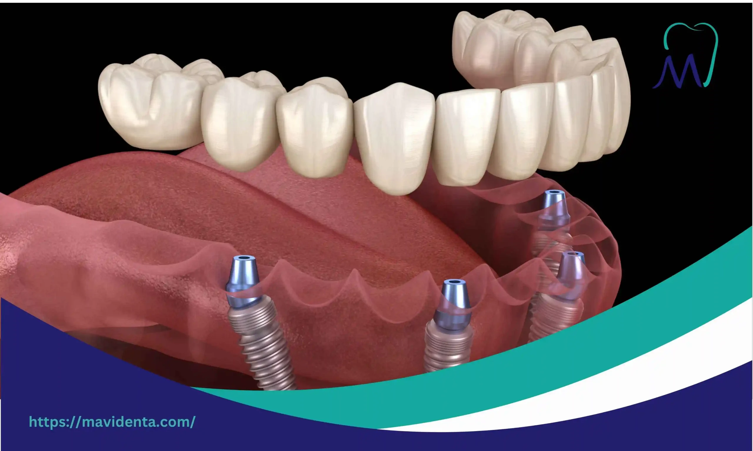 Affordable Permanent False Teeth Price in Turkey permanent false teeth price