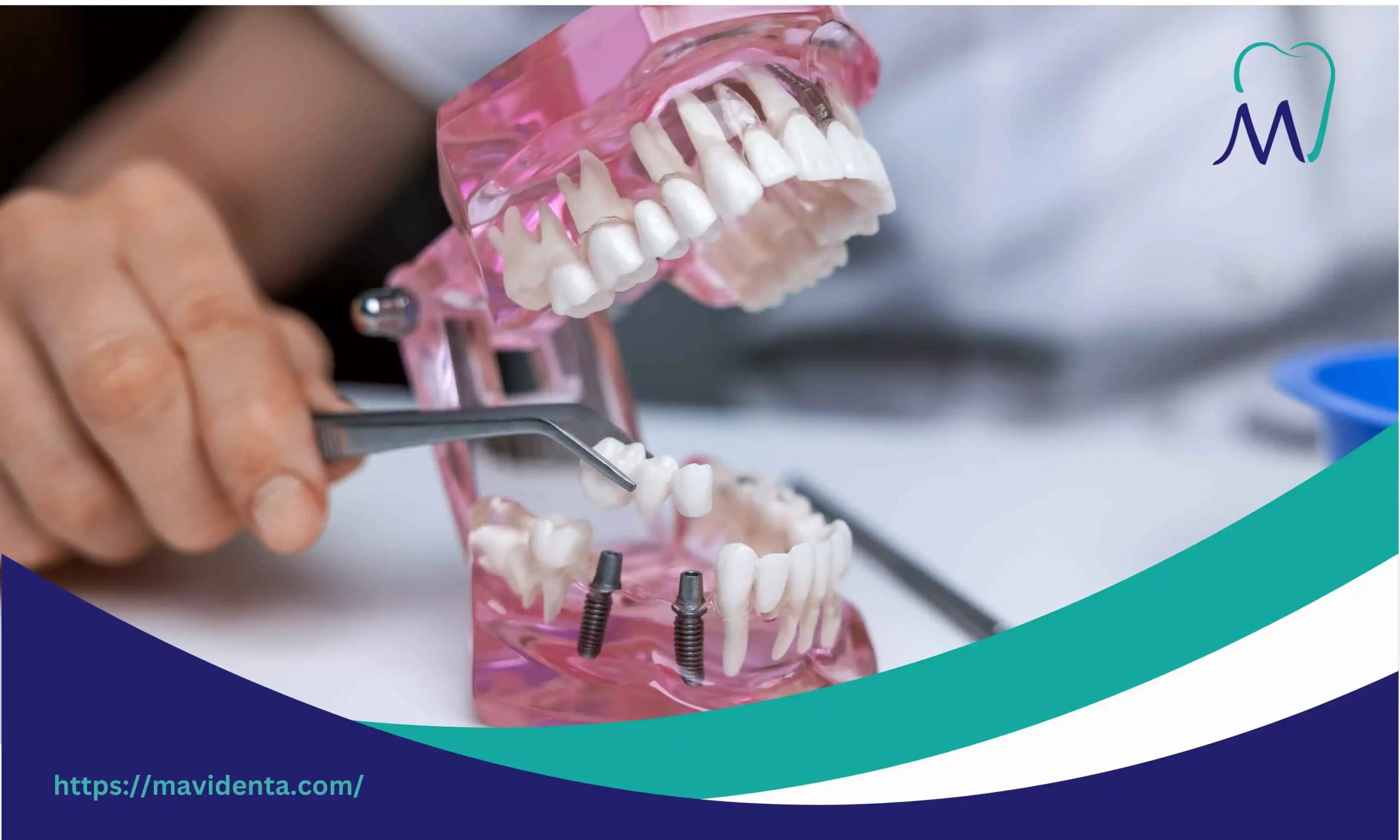 Price of Full Mouth Dental Implants in Turkey Today price of full mouth dental implants