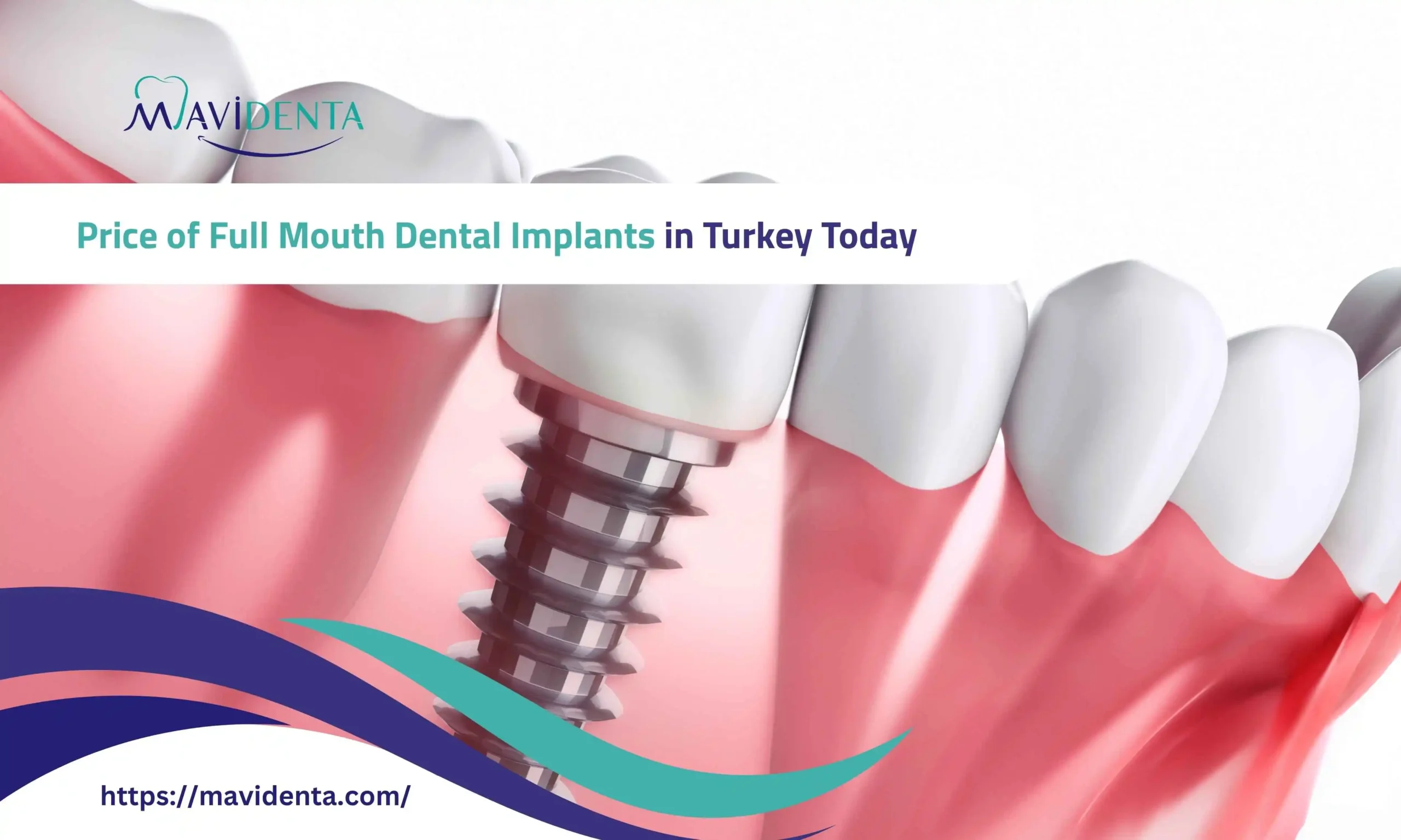 price of full mouth dental implants