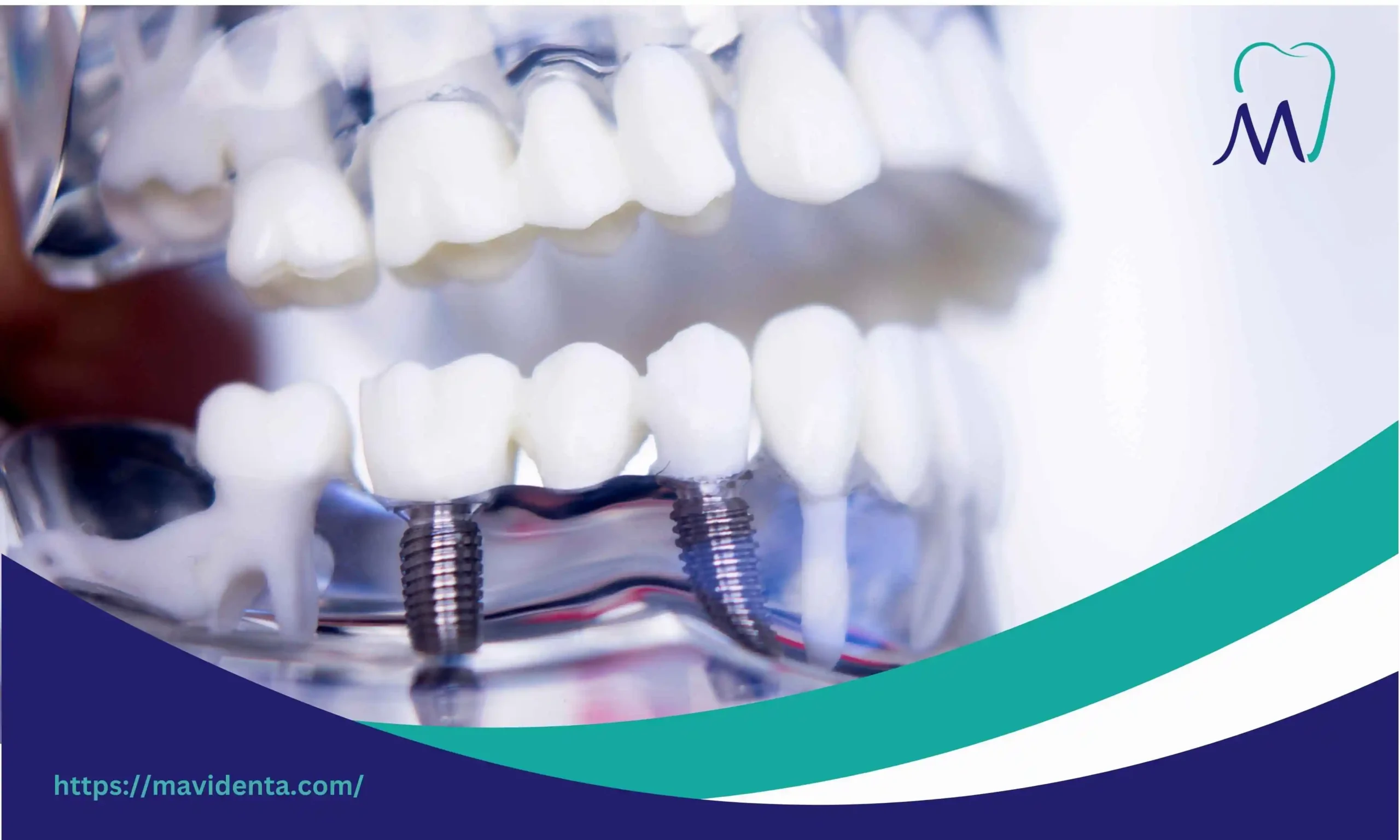 Screw In Teeth Turkey Guide for Affordable Implants screw in teeth turkey