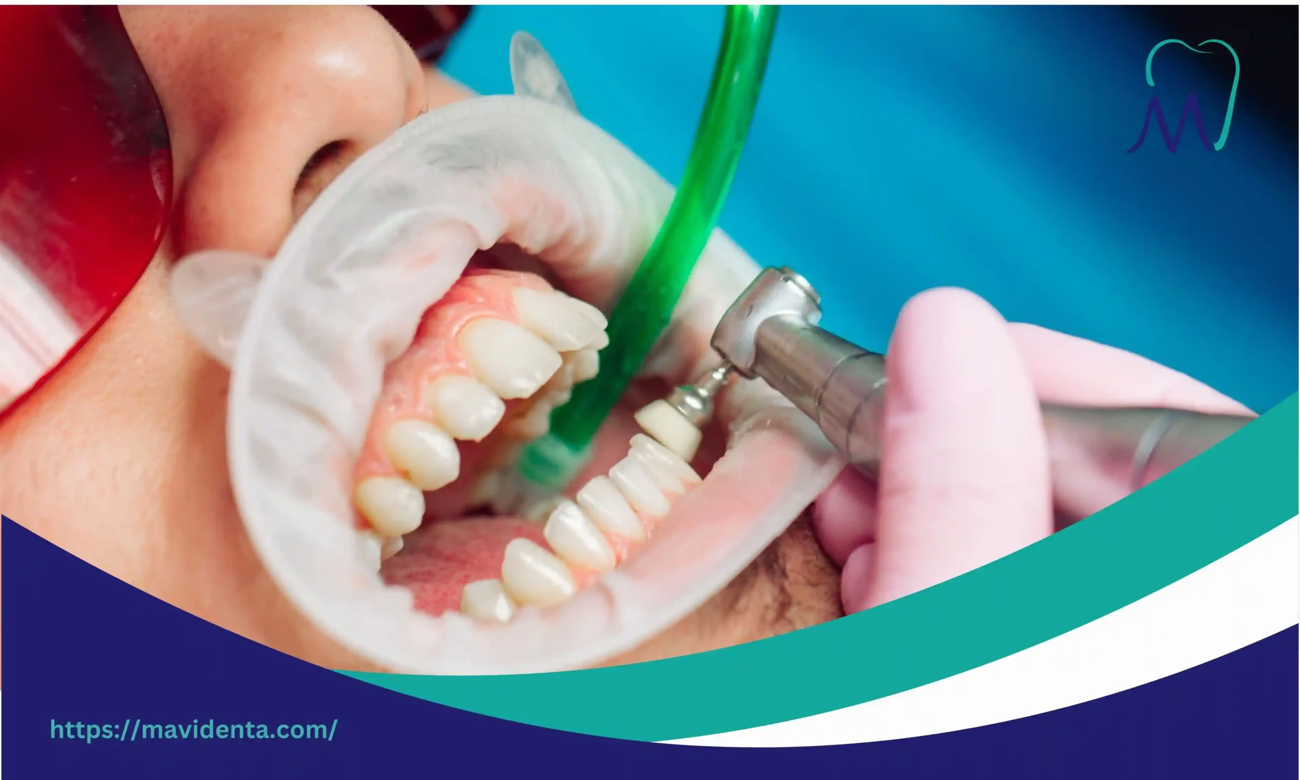 teeth lumineers price