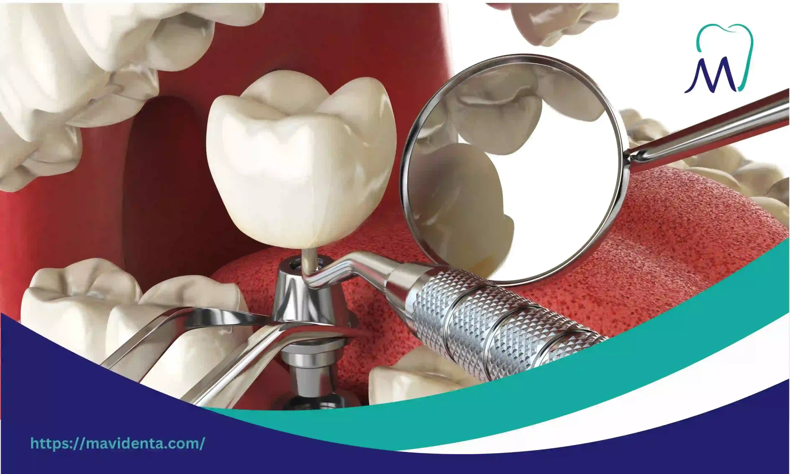 Turkey Full Set Dental Implants Cost and Procedure Guide turkey full set dental implants