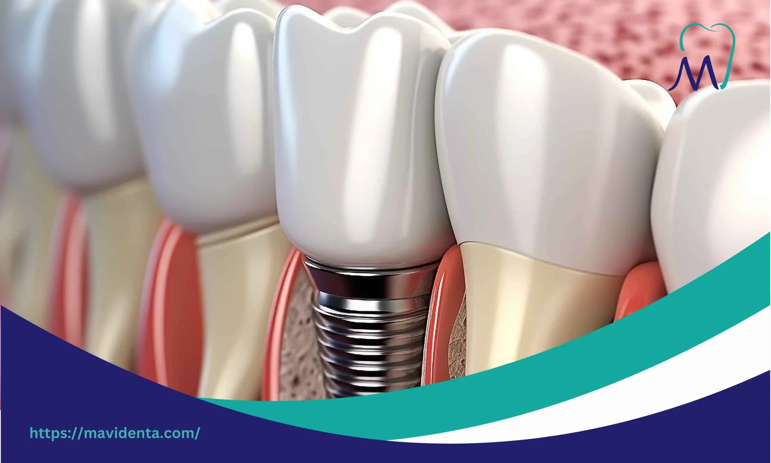 Turkey Full Set of Teeth Cost and Treatment Overview turkey full set of teeth