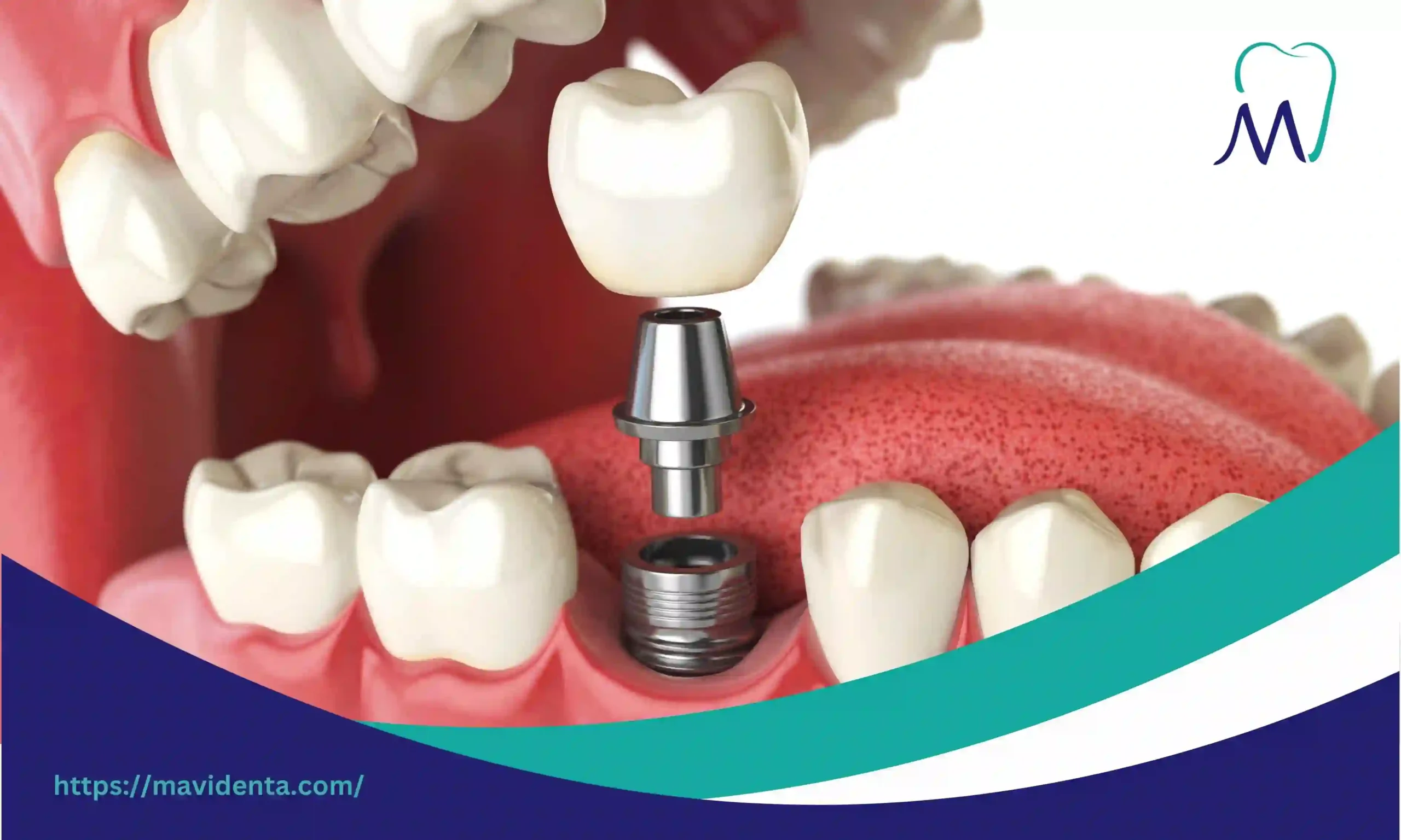 turkey teeth crowns price